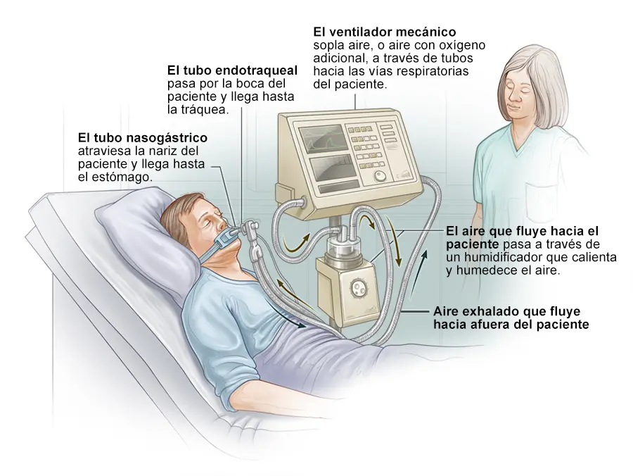 como ventilar a un paciete con preclamsia - Cómo estabilizar la preeclampsia