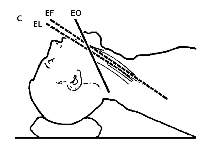 Alineación de Ejes de la Vía Aérea en Ventilación: Técnicas y Consideraciones - Cómo se debe realizar la apertura de la vía aérea alineación de ejes de la via aerea en ventilación - Cómo se debe realizar la apertura de la vía aérea