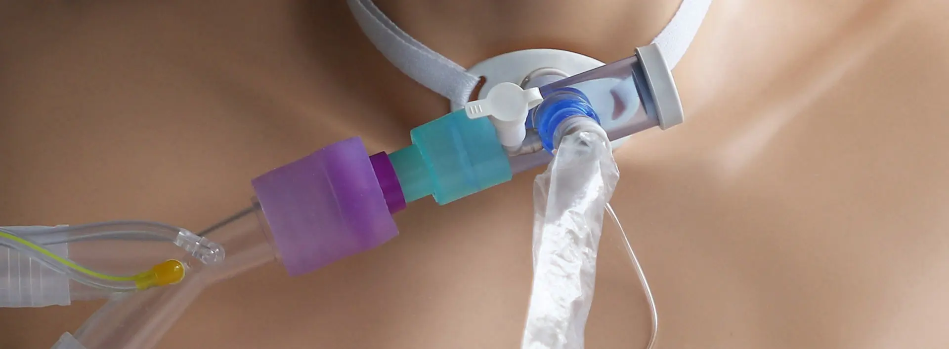 Traqueotomía sin Ventilador Mecánico: Una Guía Completa - Cuáles son los tipos de traqueotomía traqueotomia sin ventilador mecanico - Cuáles son los tipos de traqueotomía