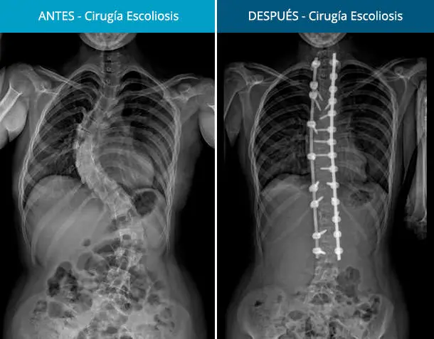 Cirugía de Columna Escoliosis en Pacientes Ventilados - Cuánto tiempo es la recuperación de una cirugía de escoliosis ciruguia de columna escoliosis en pacientes ventilados - Cuánto tiempo es la recuperación de una cirugía de escoliosis