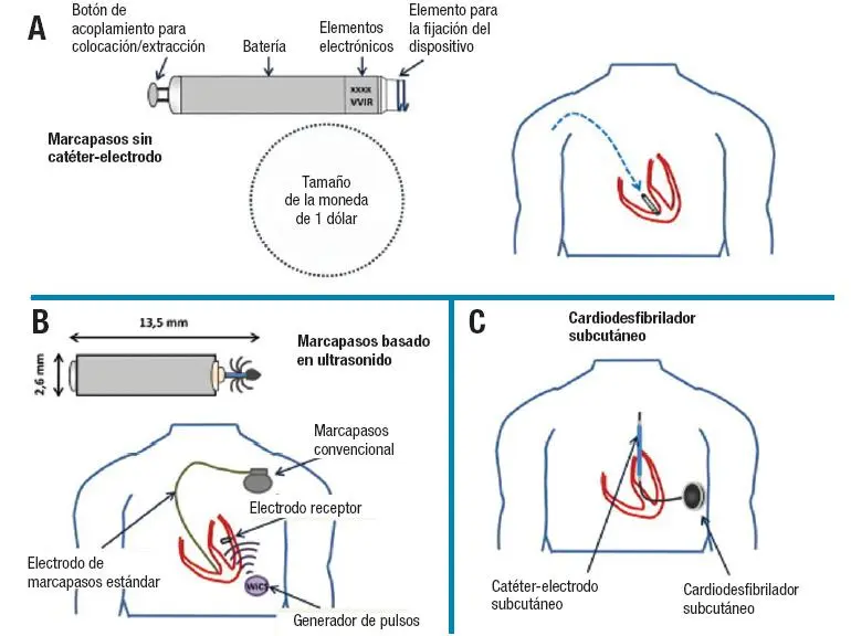 Estructura General del Marcapasos como Método de Ventilación Minuto - Cuántos modos tiene el modo de marcapasos estimulación estructura general del marcapaos como metodo minute ventilation - Cuántos modos tiene el modo de marcapasos estimulación