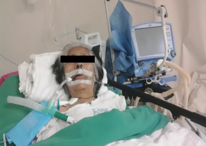 Tubo en T Ventilación: Guía Completa y Preguntas Frecuentes - Dónde se coloca el tubo en T tubo en t ventilación - Dónde se coloca el tubo en T