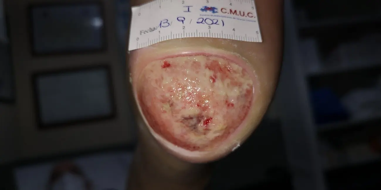 paciente diabético con upp en ventilación mecánica - Qué cuidados de enfermería se deben realizar a pacientes que tienen UPP