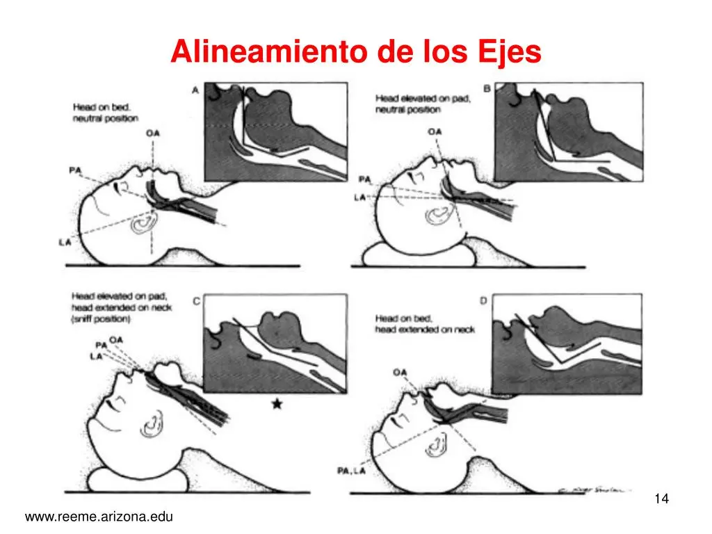 Alineación de Ejes de la Vía Aérea en Ventilación: Técnicas y Consideraciones - Qué ejes se alinean para intubar alineación de ejes de la via aerea en ventilación - Qué ejes se alinean para intubar