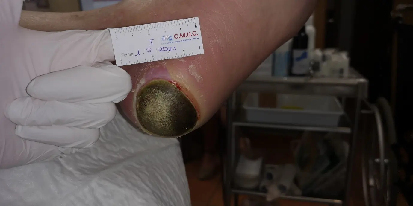 paciente diabético con upp en ventilación mecánica - Qué es el Protocolo de UPP