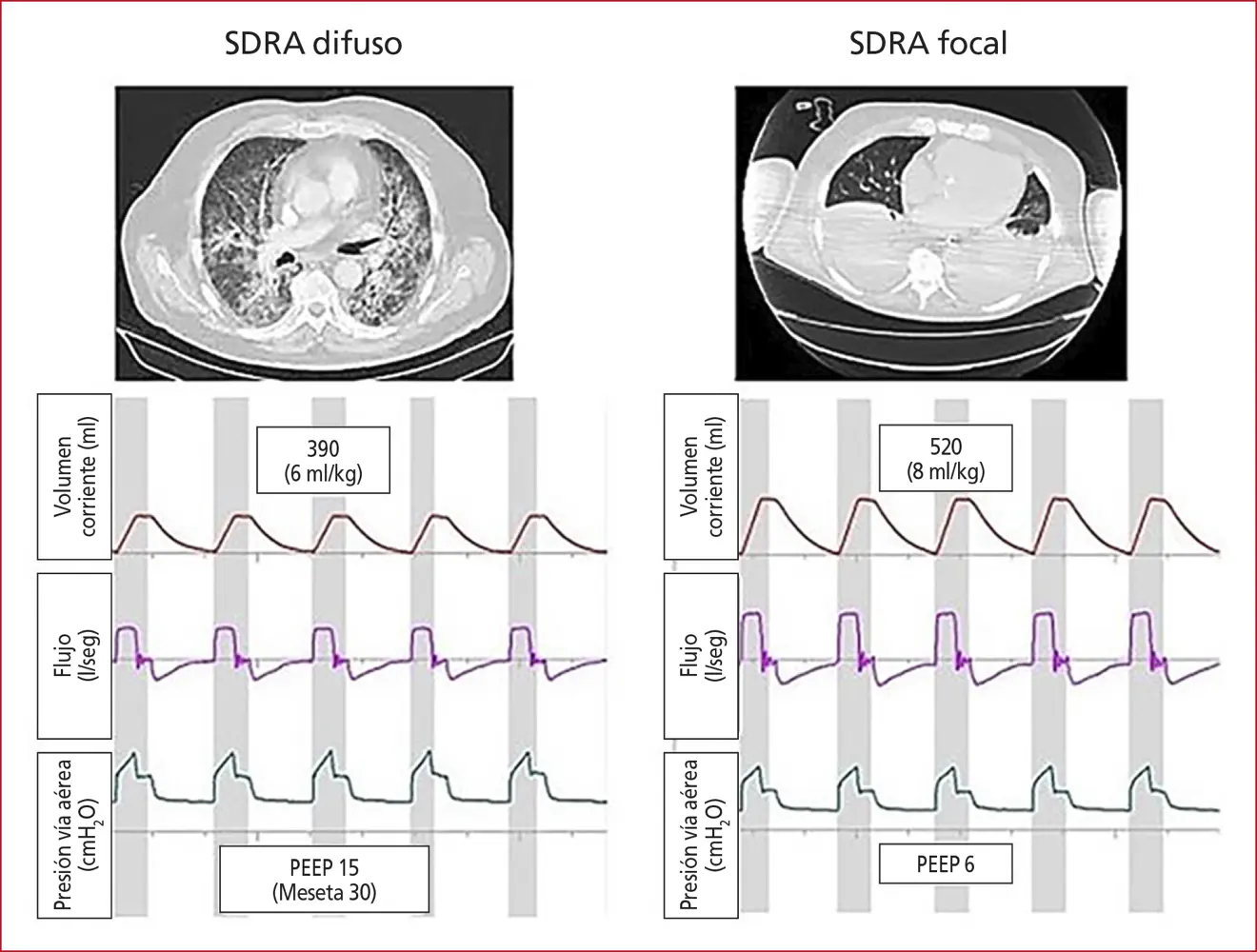 Síndrome de Dificultad Respiratoria Aguda (ARDS): Un Análisis Profundo y su Tratamiento con Ventilación Mecánica - Qué es el síndrome de ARDS estudio del grupo ards-network se consolida la ventilación - Qué es el síndrome de ARDS