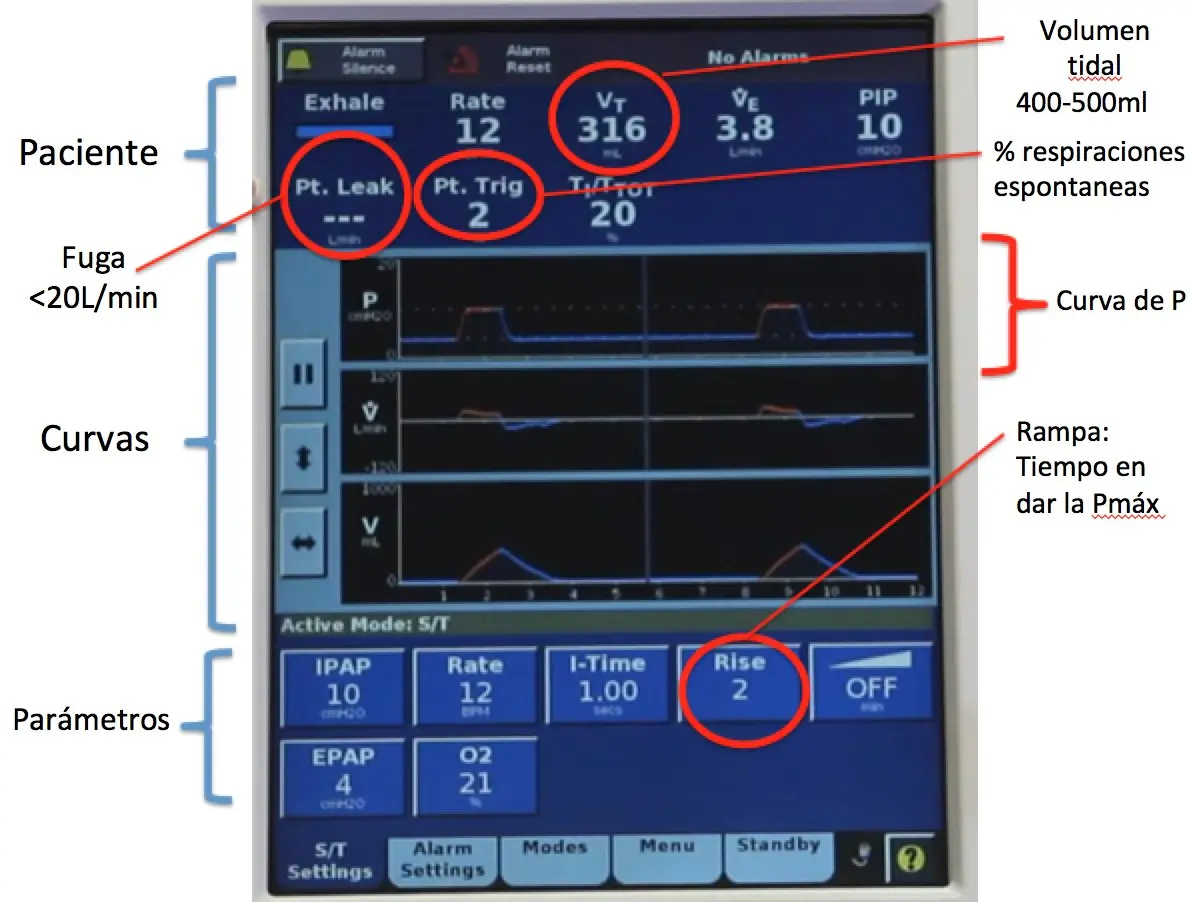 ipap ventilador - Qué es la EPAP
