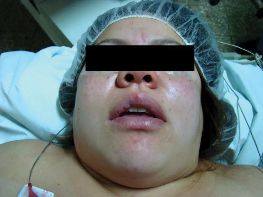 como ventilar a un paciete con preclamsia - Qué es la preeclampsia cuidados de enfermería