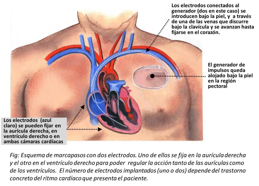 Estructura General del Marcapasos como Método de Ventilación Minuto - Qué estructura del sistema de conducción del corazón es llamado el marcapaso estructura general del marcapaos como metodo minute ventilation - Qué estructura del sistema de conducción del corazón es llamado el marcapaso