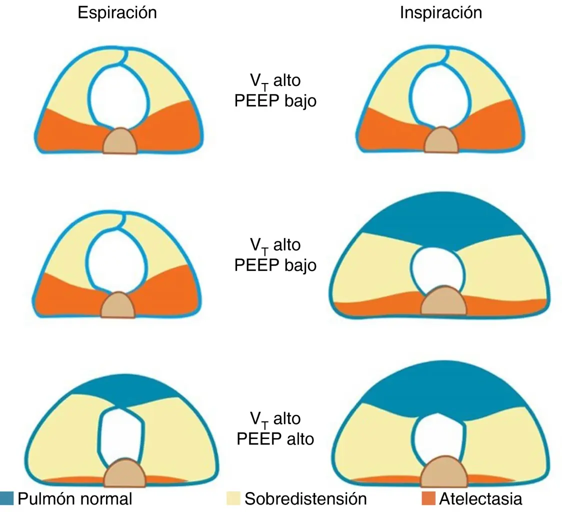 peep maximo ventilación - Qué significa que el PEEP este alto