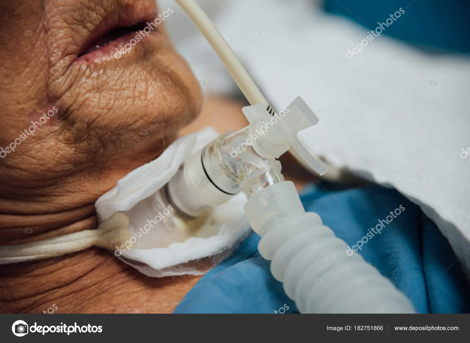 traqueostomia con ventilador - Qué tipo de ventilacion es la traqueostomía