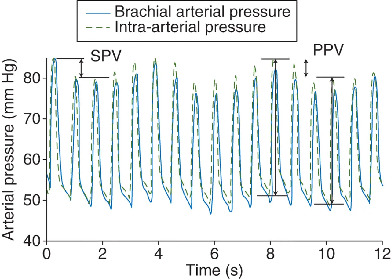 Variación de la Presión del Pulso Arterial con Ventilación Mecánica - What causes pulse pressure variation arterial pulse pressure variation with mechanical ventilation - What causes pulse pressure variation