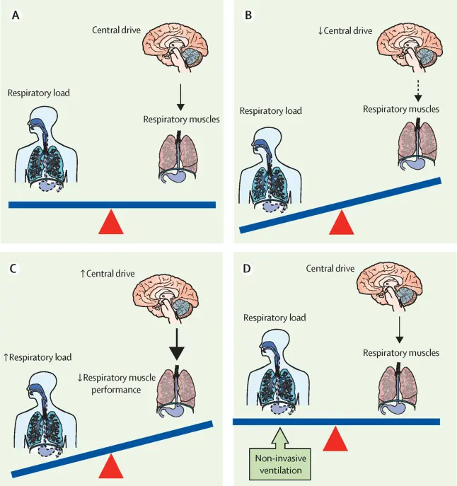 Ventilación No Invasiva (VNI) en Niños: Una Guía Completa - What is NIV ventilation in children norregaard o noninvasive ventilation in children - What is NIV ventilation in children