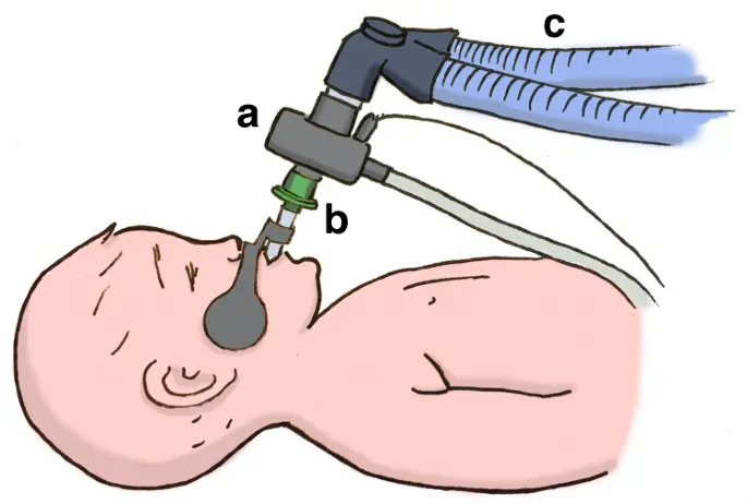 dead space mechanical ventilation - What is the dead space in the airway