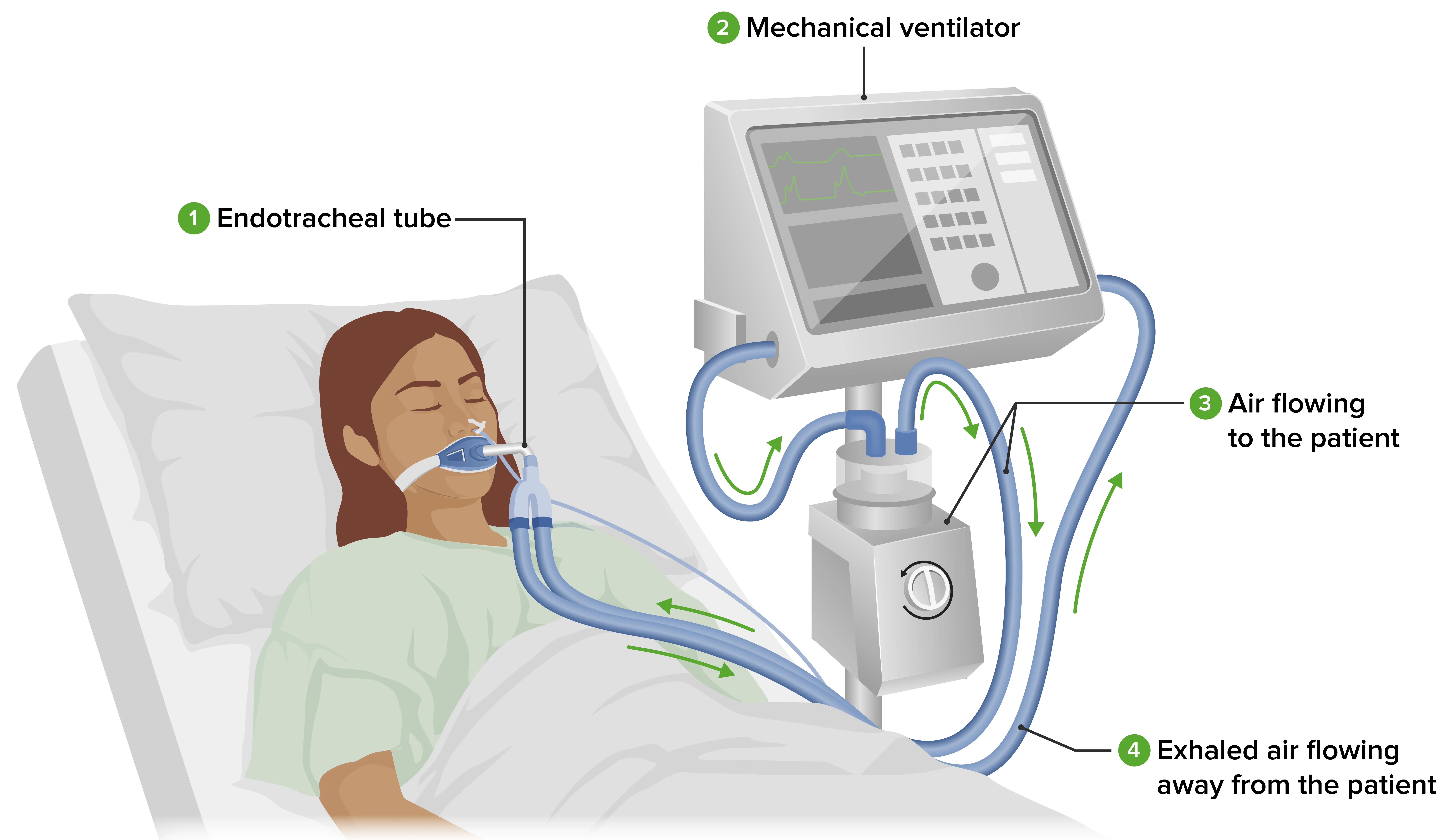 Ventilación Mecánica Asistida en Niños: Una Guía para Padres - What is the difference between VTI and VTE referred mechanical ventilation - What is the difference between VTI and VTE