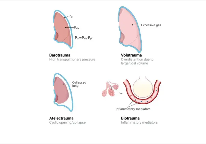 Ventilación Protectora Pulmonar: Estrategias para el SDRA - What is the lung protective ventilation peep protective ventilation network provenet - What is the lung protective ventilation peep