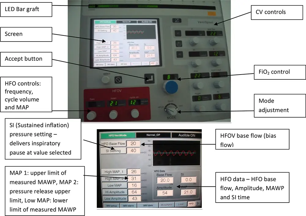¿Qué es la configuración MAP en la Ventilación de Alta Frecuencia Oscilatoria (HFOV)? - What is the map setting for HFOV hfo ventilation settings - What is the map setting for HFOV