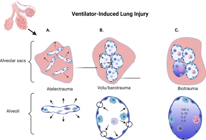 Ventilación Mecánica Invasiva (VMI) y Lesión Pulmonar Inducida por Ventilador (VILI) - What is the meaning of VILI vili mechanical ventilation - What is the meaning of VILI