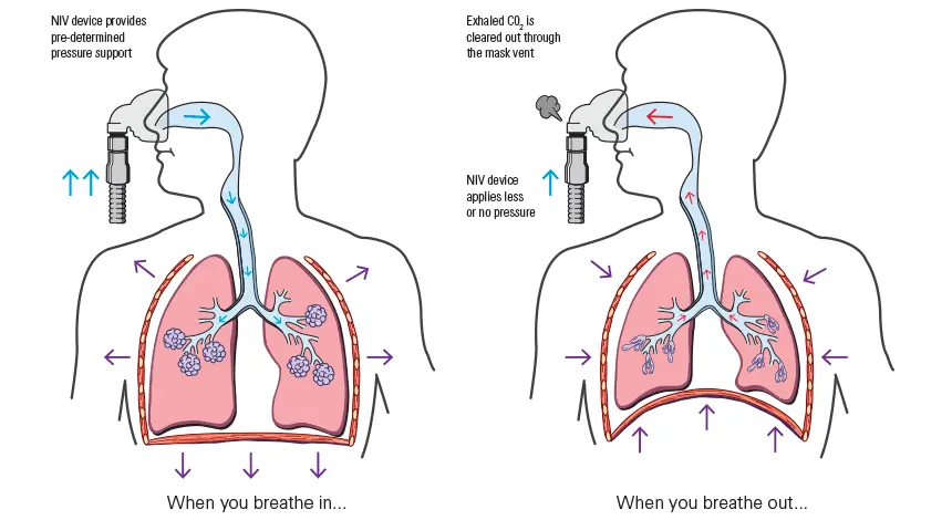 niv ventilation and pneumocysti - Why is NIV contraindicated in pneumothorax
